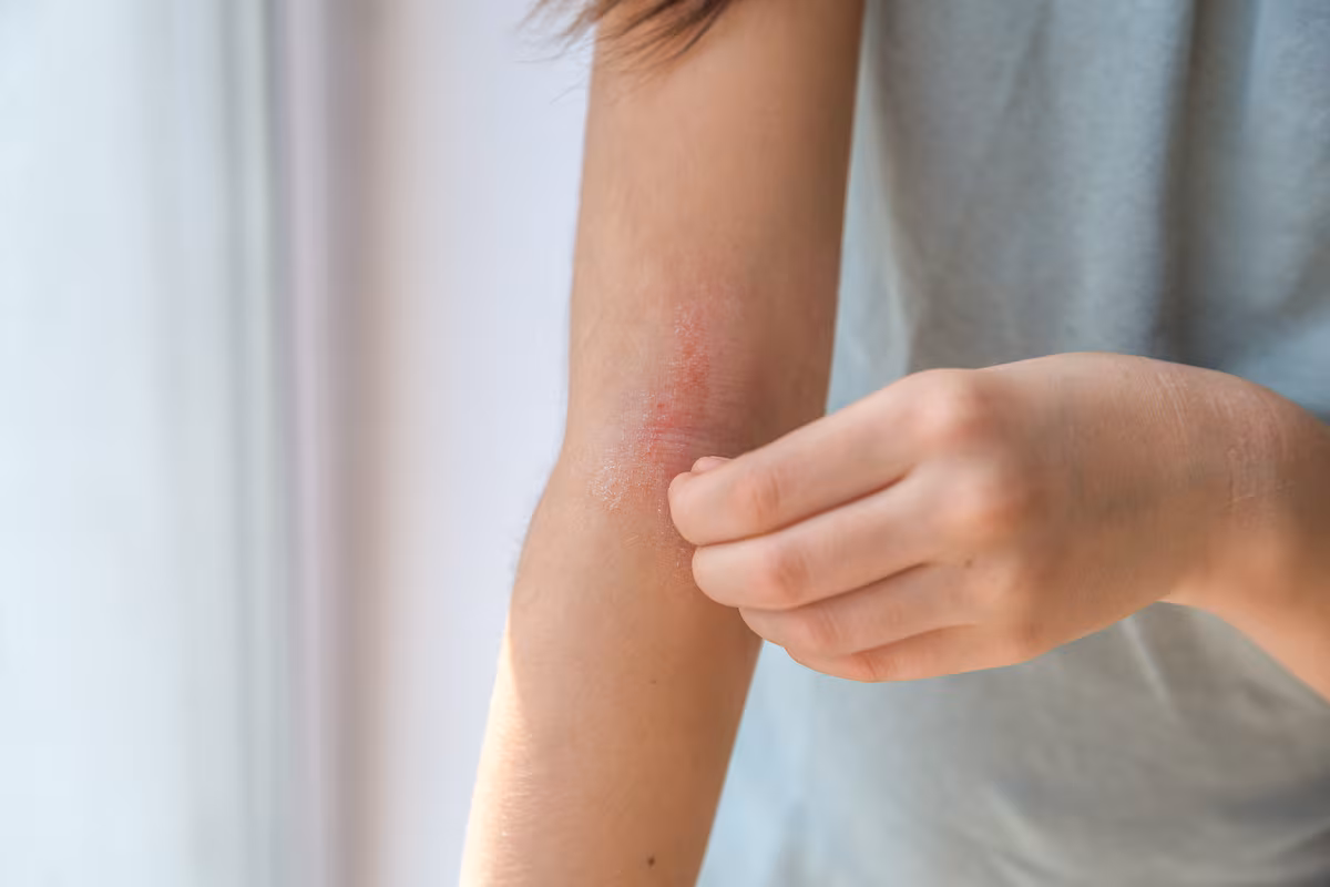 Dermatitis atópica y psoriasis: su impacto en la piel y la salud mental